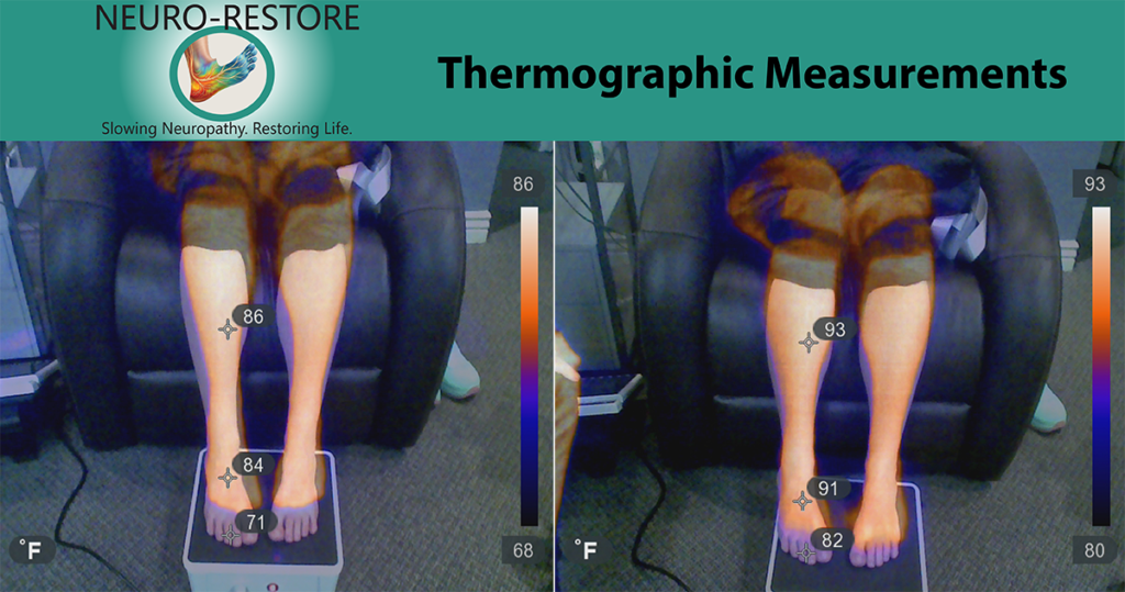 Infrared thermography scan used to evaluate neuropathy at a Midvale, UT clinic